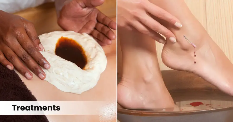 Ayurvedic Treatment for Lumbar Spondylosis