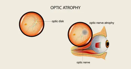 Ayurvedic Treatment for Optic Nerve Atrophy