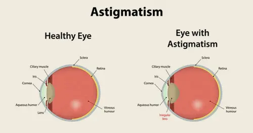 Ayurvedic Treatment for Astigmatism