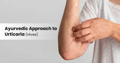 Ayurvedic Approach to Urticaria (Hives)