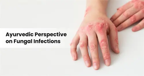 Ayurvedic Treatment for Fungal Infections: Understanding, Management, and Prevention