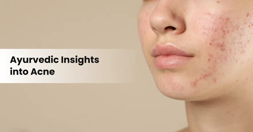 Ayurvedic Insights into Acne