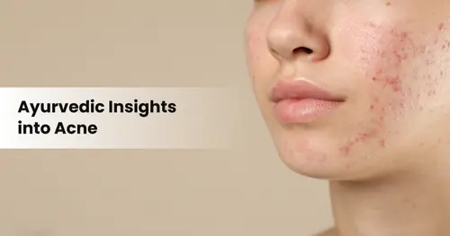 Ayurvedic Insights into Acne