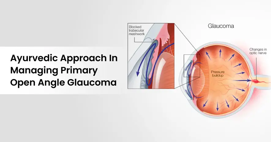 Ayurvedic Approach In Managing Primary Open Angle Glaucoma