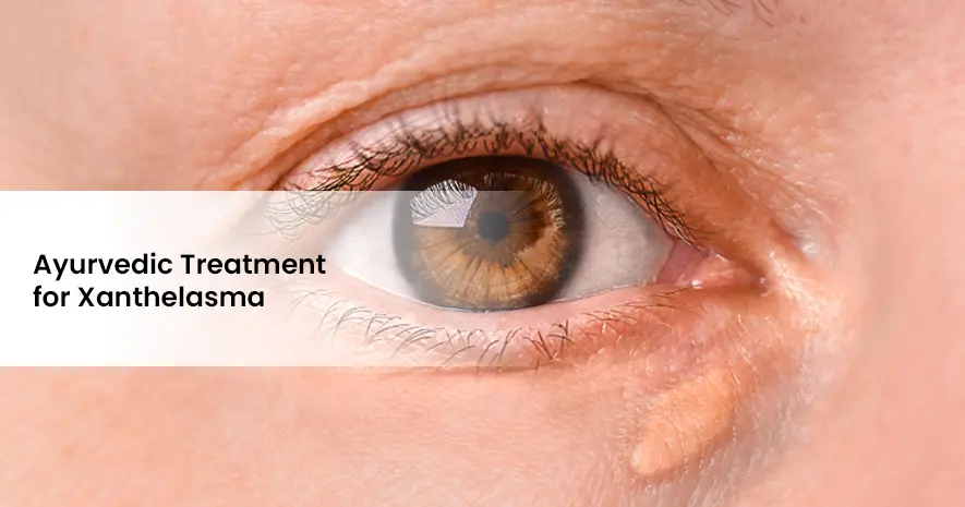 Ayurvedic Treatment for Xanthelasma