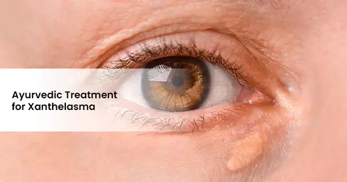 Ayurvedic Treatment for Xanthelasma