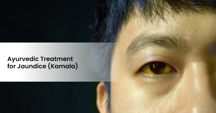 Ayurvedic Treatment for Jaundice (Kamala)