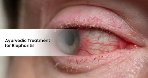 Ayurvedic Treatment for Blepharitis