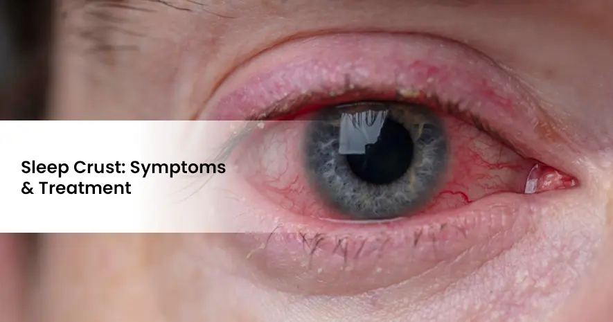 Sleep Crust: Symptoms and Treatment