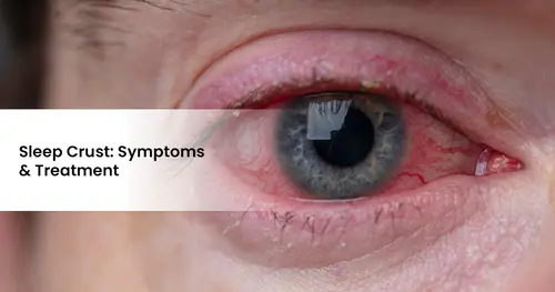 Sleep Crust: Symptoms and Treatment