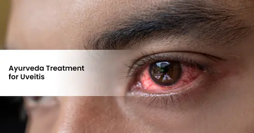 Ayurveda Treatment for Uveitis