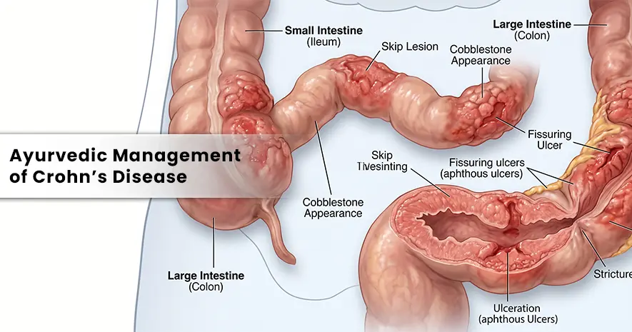 Ayurvedic Management of Crohn’s Disease