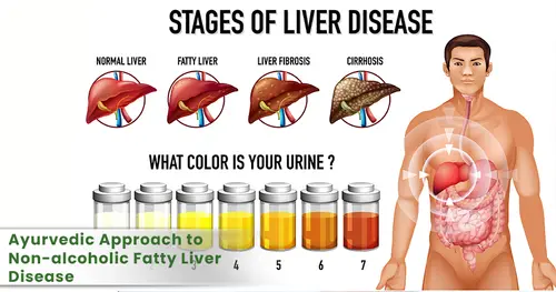 Reclaiming Liver Health – An Ayurvedic Approach to Non-alcoholic Fatty Liver Disease (NAFLD) 