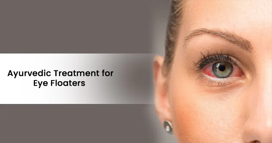 Ayurvedic Treatment for Eye Floaters