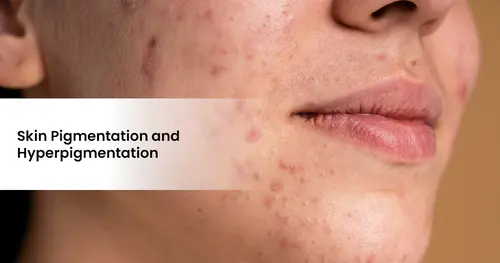 Skin Pigmentation and Hyperpigmentation: Ayurvedic Remedies and Blood Purifiers 