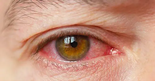 Ayurvedic Treatment for Dry Eyes