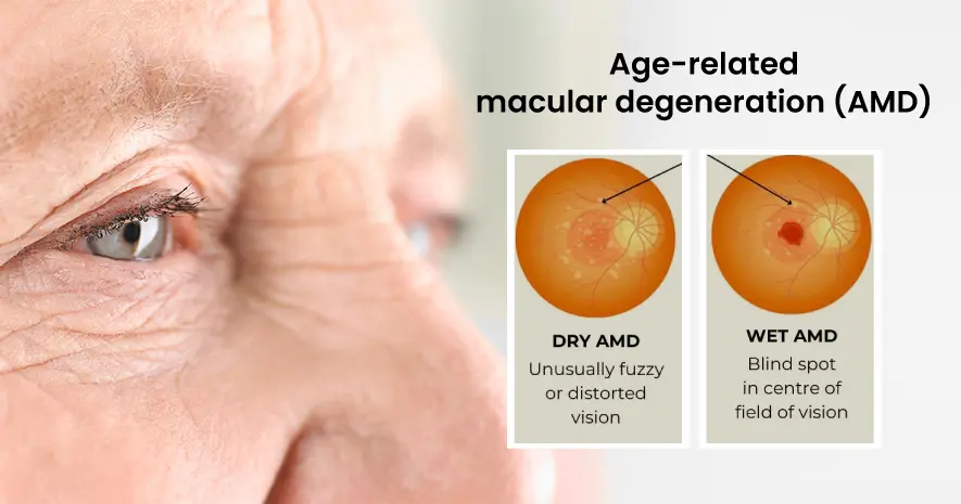 Understanding of Age-related Macular Degeneration (AMD) 