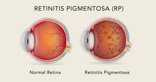 Ayurvedic Treatment For Retinitis Pigmentosa