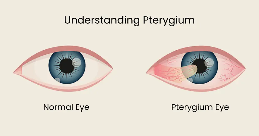 Ayurvedic Treatments for Pterygium