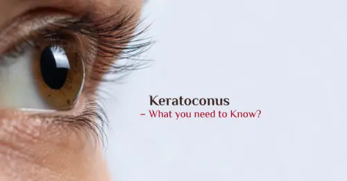 Keratoconus – What you need to Know?
