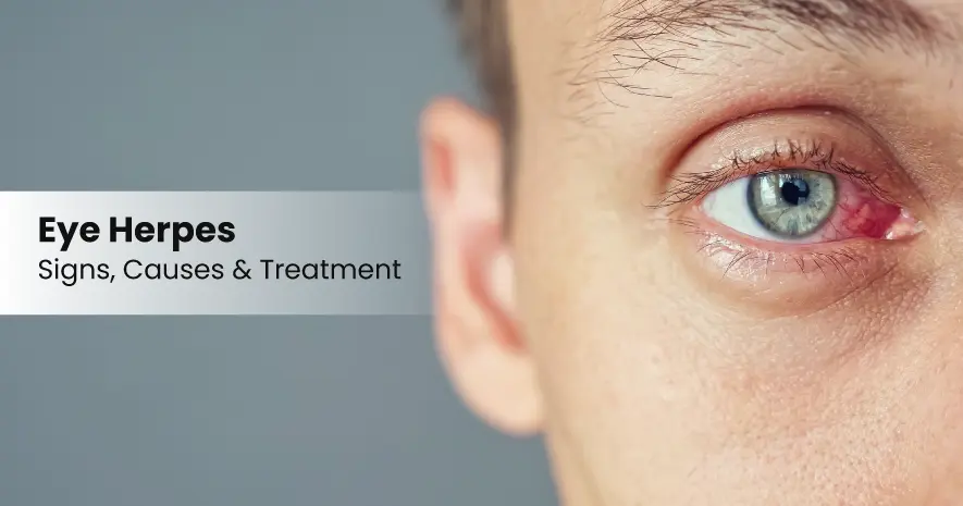 Eye Herpes - Signs, Causes and Treatment