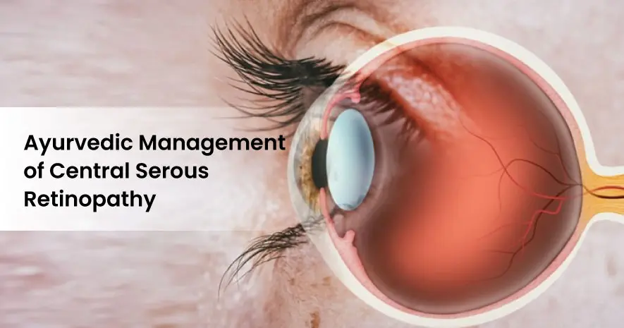Ayurvedic Management of Central Serous Retinopathy