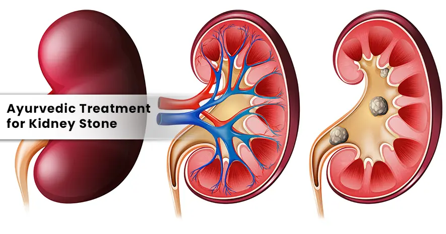 Ayurvedic Treatment for Kidney Stone