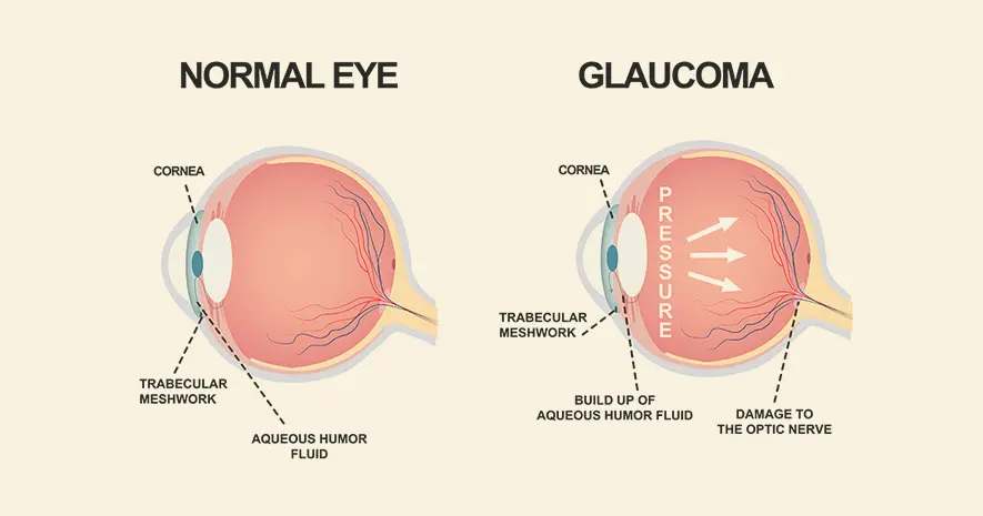 Glaucoma: What You Need to Know About This Condition  