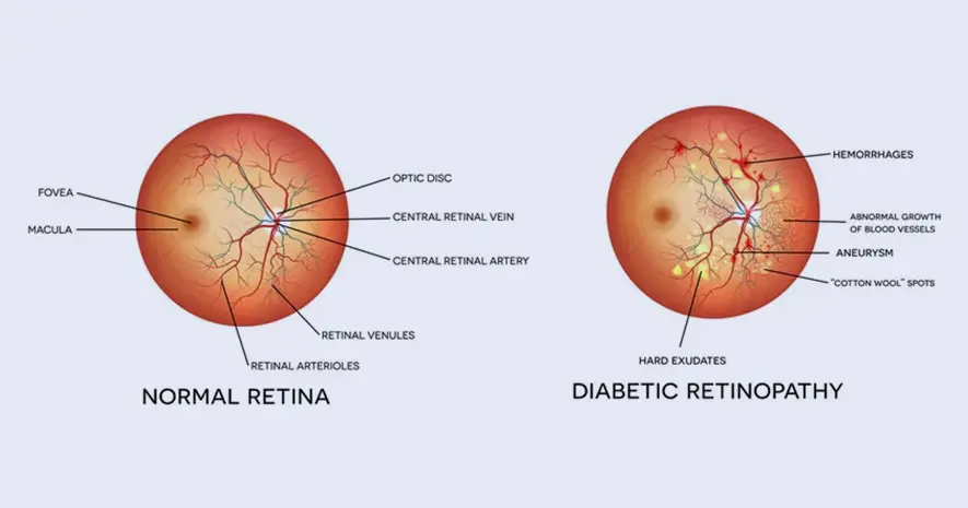 Diabetes and Your Eyes: What is Diabetic Retinopathy and How to  Manage It with Ayurveda