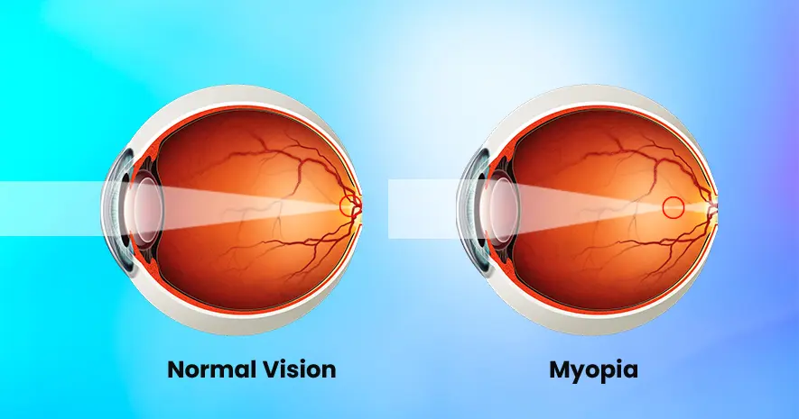 Ayurvedic Treatment for Myopia