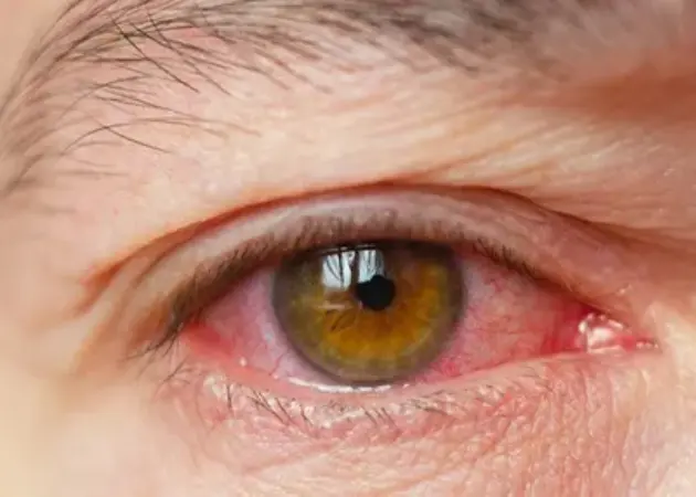 Dry Eyes