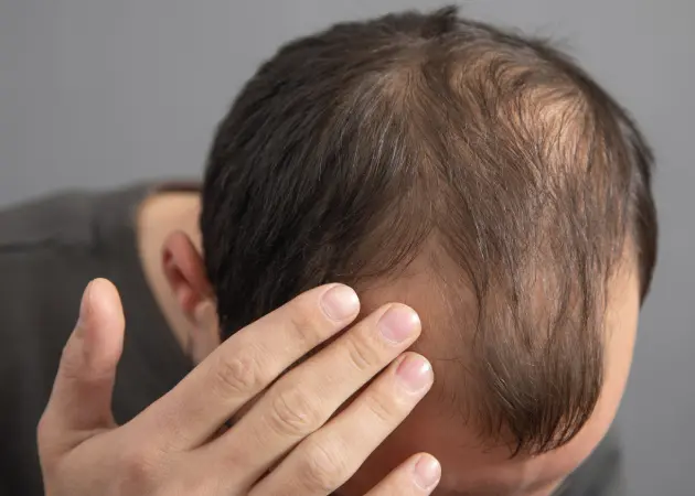 Alopecia