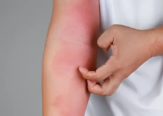 Ayurvedic Management for Eczema