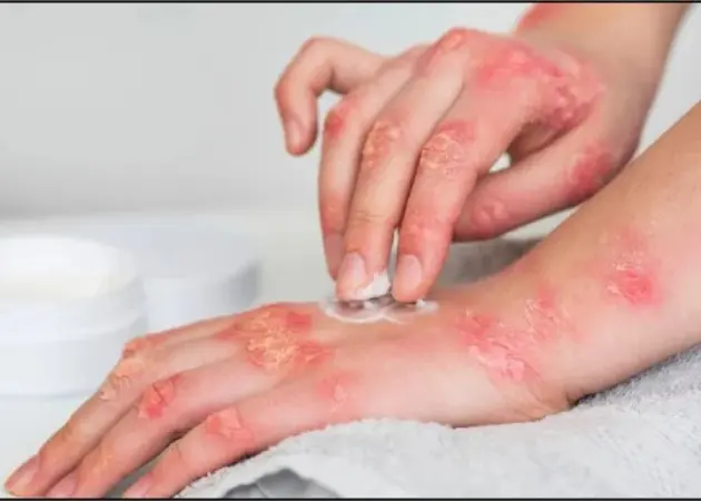 Ayurvedic Management for Psoriasis