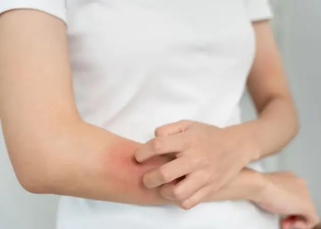 Allergic Dermatitis