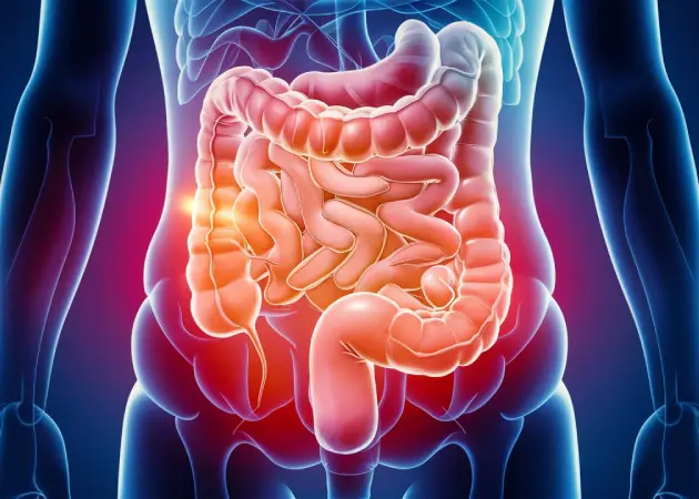 Irritable Bowel Syndrome (IBS)